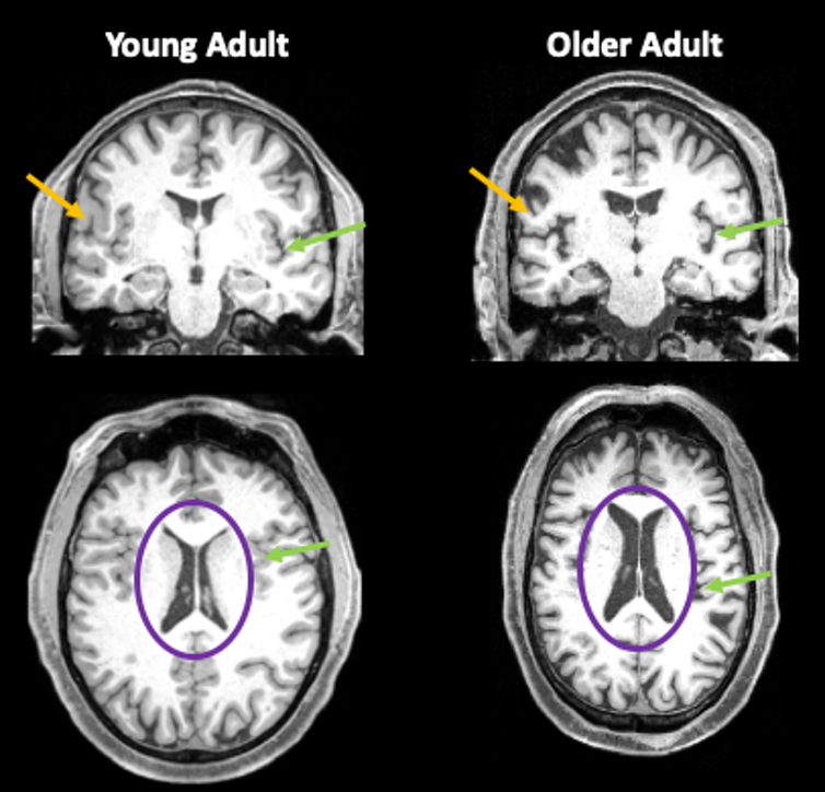 View of a young adult brain and an older adult brain 